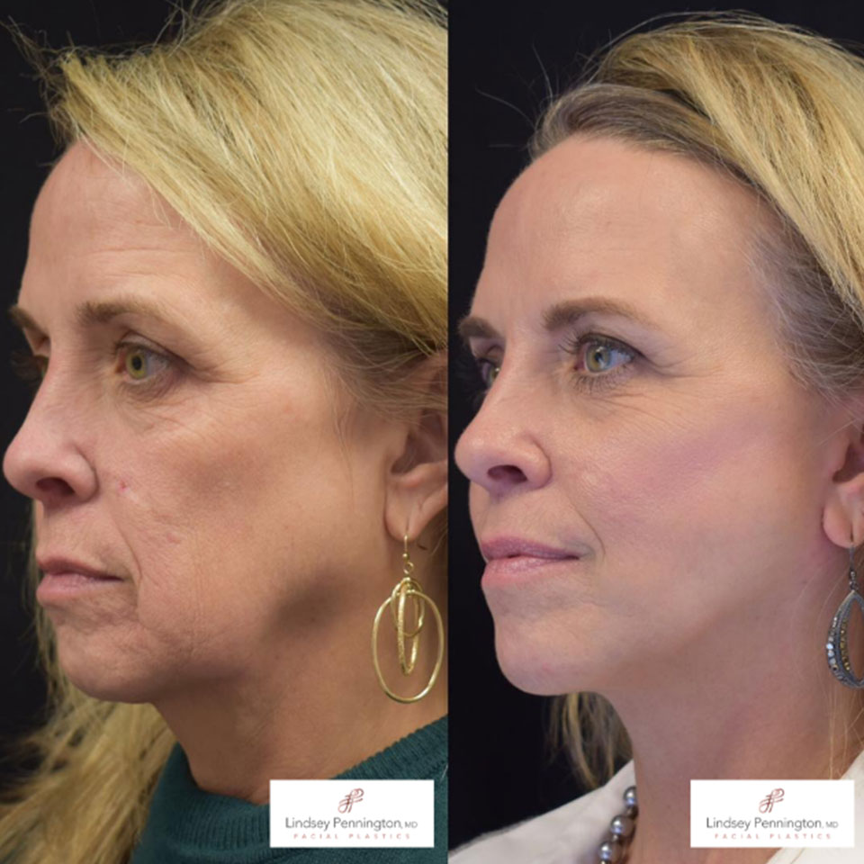 Facelift Before After Gallery - Pennington