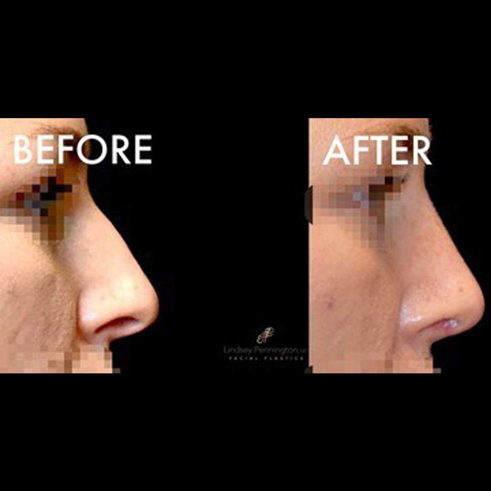 Rhinoplasty Before After Gallery - Pennington