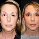 plastic surgery before and after photo