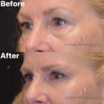 Blepharoplasty before and after photo