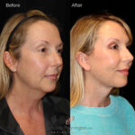 Facelift before and after photo