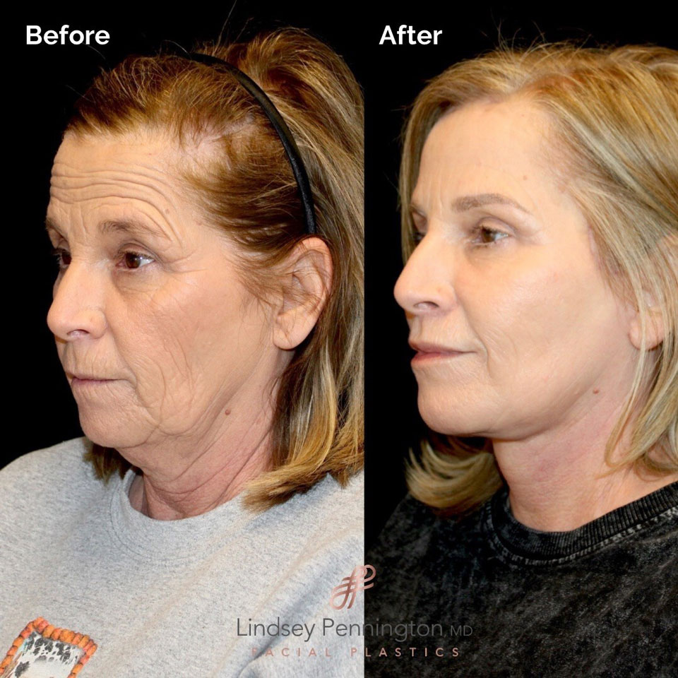 Facelift_slide-31-img Facelift before and after photo