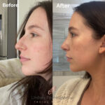 Facelift before and after photo