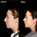 Facelift before and after photo