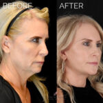 Facelift before and after photo