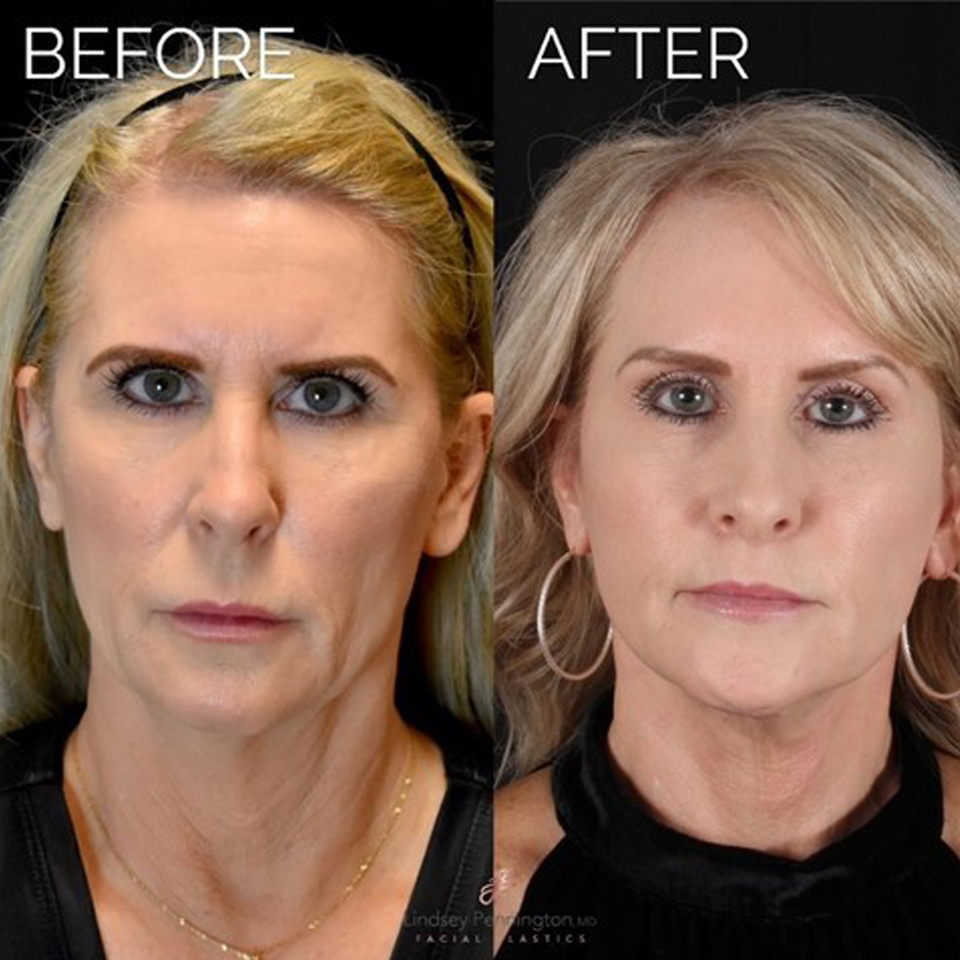 Facelift before and after photo