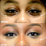 Dermal Filler before and after photo