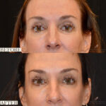 Dermal Filler before and after photo