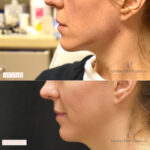 Dermal Filler before and after photo