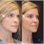 Dermal Filler before and after photo
