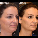 Dermal Filler before and after photo