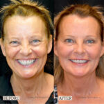 Dermal Filler before and after photo
