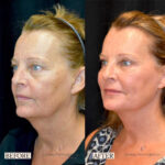 Dermal Filler before and after photo