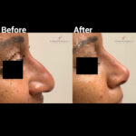 Dermal Filler before and after photo