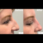 Dermal Filler before and after photo