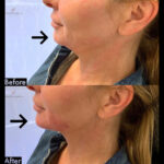 Dermal Filler before and after photo