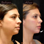 Dermal Filler before and after photo