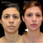 Dermal Filler before and after photo