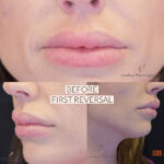 Dermal Filler before and after photo