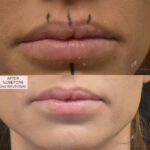 Dermal Filler before and after photo