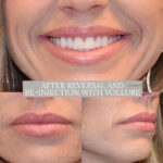Dermal Filler before and after photo