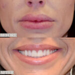 Dermal Filler before and after photo