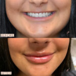 Dermal Filler before and after photo
