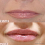 Dermal Filler before and after photo