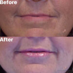 Dermal Filler before and after photo