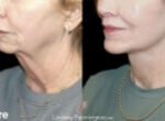 plastic surgery before and after photo