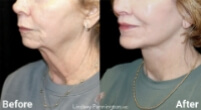 Image 278 plastic surgery before and after photo