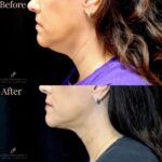 Kybella before and after photo