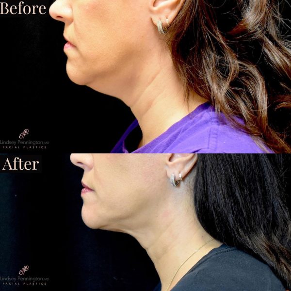 Kybella before and after photo