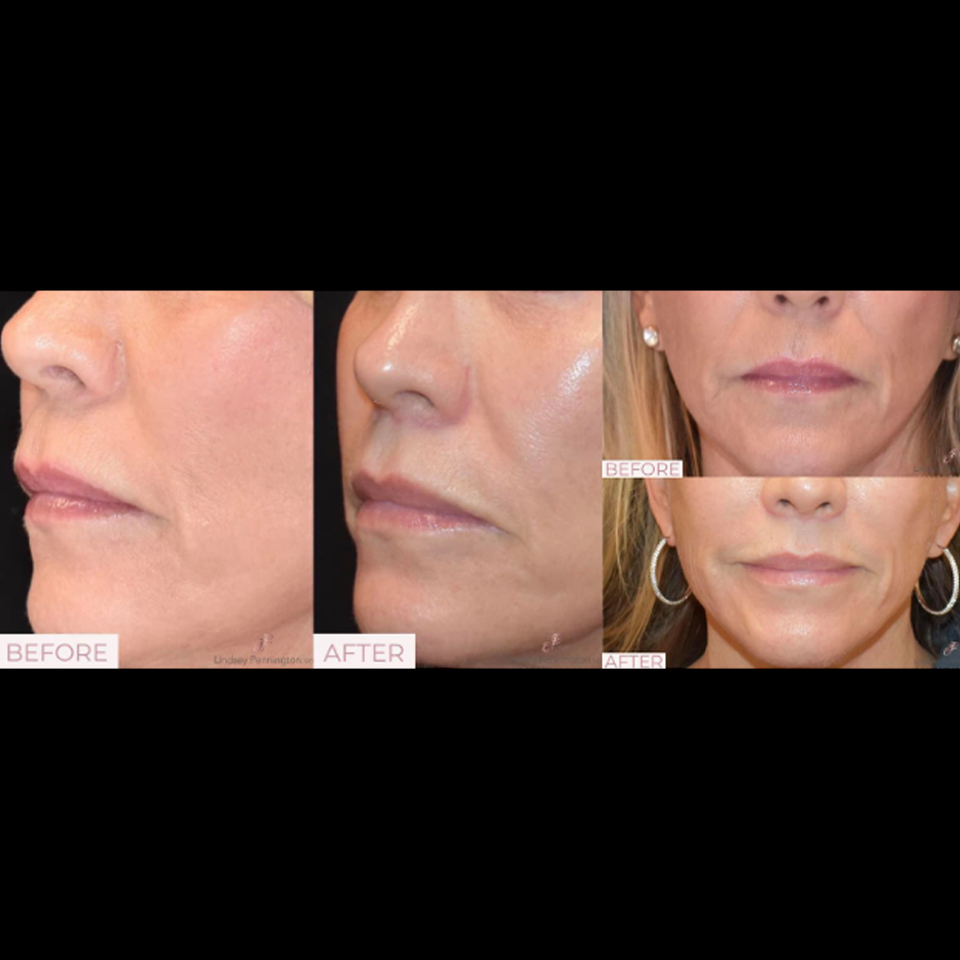 Lip Lift before and after photo