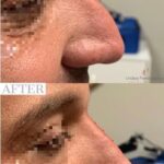 Liquid Rhinoplasty before and after photo