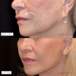 Lip Lift before and after photo