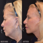 Lip Lift before and after photo