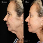 plastic surgery before and after photo
