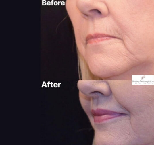 plastic surgery before and after photo