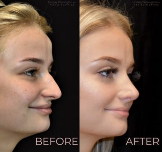 plastic surgery before and after photo
