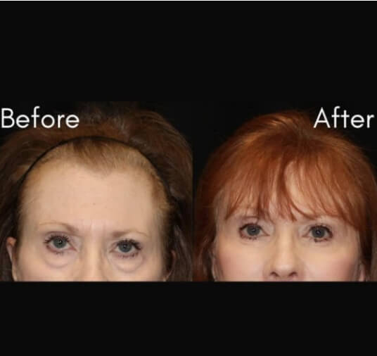 plastic surgery before and after photo