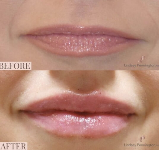 lip filler before and after photo