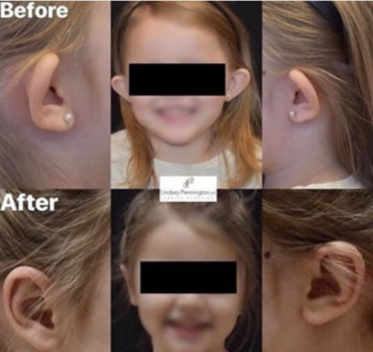 kid otoplasty before and after photo