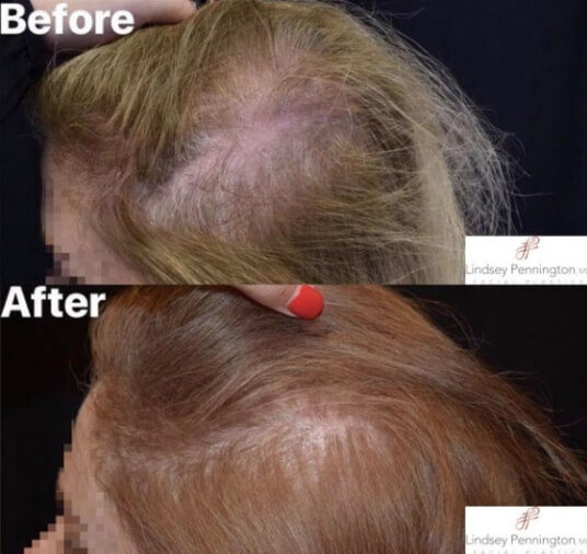 hair restoration before and after photo