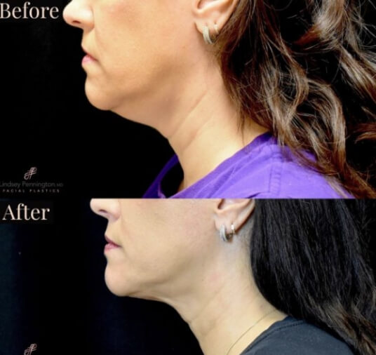 plastic surgery before and after photo