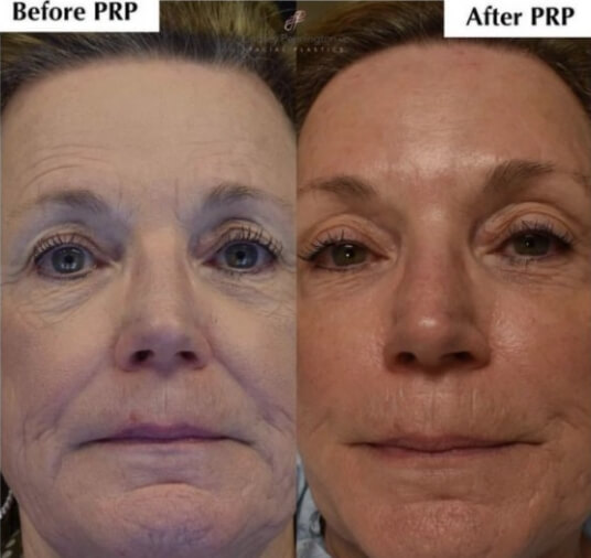 plastic surgery before and after photo