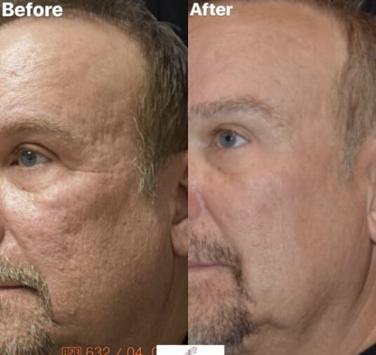 plastic surgery before and after photo