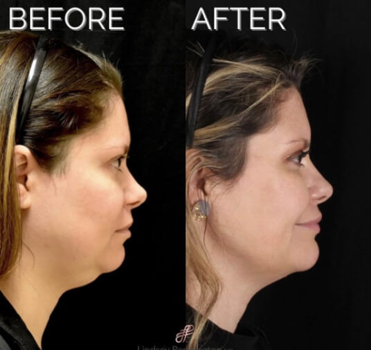 plastic surgery before and after photo