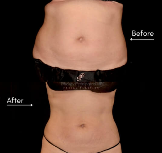 plastic surgery before and after photo