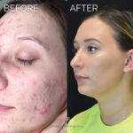 Microneedling with PRP before and after photo